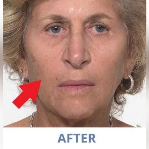 2 Plexaderm Rapid Reduction Advanced Serum AS SEEN ON TV's Best Selling Skincare - Picture 5 of 15